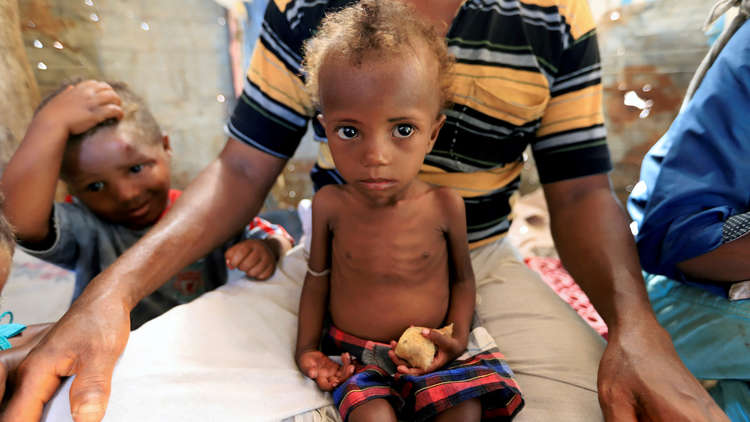إرتفاع حالات الكوليرا في اليمن